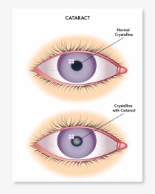 Cataract-symptoms - Cataract Symptoms, HD Png Download, Free Download