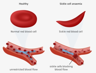 John Brown Diagnosed With Sickle Cell Trait - Red Blood Cell Sickle Cell, HD Png Download, Free Download