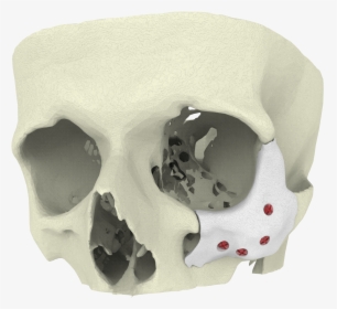 Maxillofacial Surgery Trauma 3d Printing, HD Png Download, Free Download