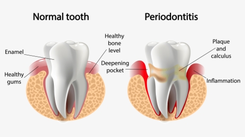 Tooth - Periodontal Disease, HD Png Download, Free Download