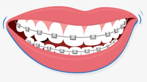 Smile With Braces Clipart, HD Png Download, Free Download