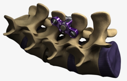Spine Zipultra-1 - Ultra Mis Lumbar Interbody Fusion, HD Png Download, Free Download