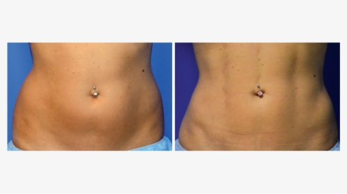 Ab Etching Before And After Woman