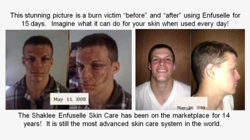 Shaklee Enfuselle - Burns - Face Burns Before And After, HD Png Download, Free Download