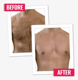 Body Hair Png - Hair Removal Men, Transparent Png, Free Download