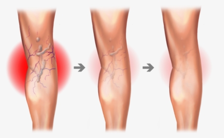 Varicose Vein Graphic, HD Png Download, Free Download