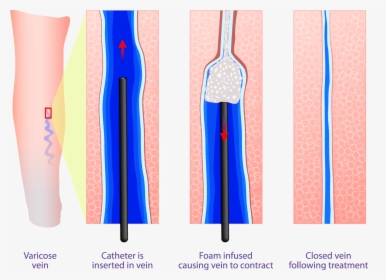 Sclerotherapy Treatment - Sclerotherapy Varicose Veins, HD Png Download, Free Download
