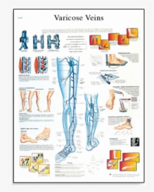 Varicose Veins Chart"   Title="varicose Veins Chart"   - Poster Varicose Vein, HD Png Download, Free Download