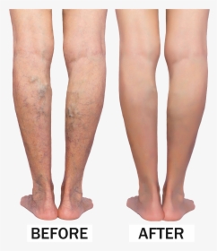 Varicose Veins Before & After - Rope Like Varicose Veins, HD Png Download, Free Download