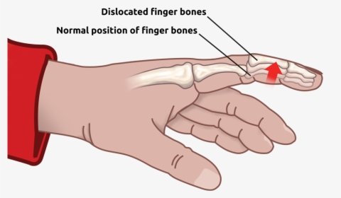 Dislocated Finger - Złamany Palec U Ręki, HD Png Download, Free Download