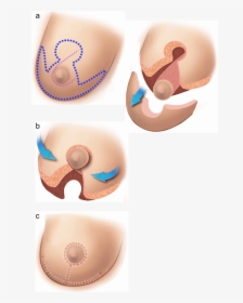 Illustration Of A Breast Reduction - Anchor Breast Reduction Surgery, HD Png Download, Free Download
