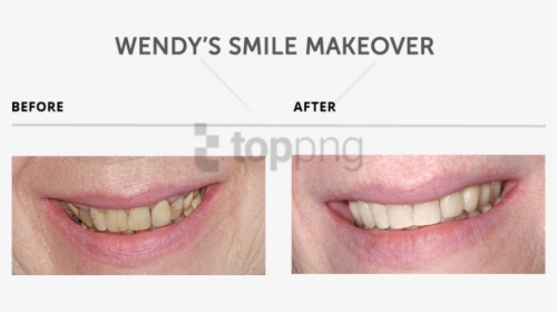 Free Png Download Teeth Makeover Png Images Background - Slim Jim, Transparent Png, Free Download