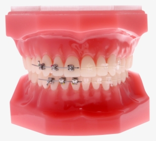 Dental-braces - Self Ligating Braces Png, Transparent Png, Free Download