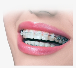 Invisalign Vs Braces - Dental Banner Images Hd, HD Png Download, Free Download