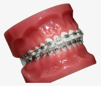 Buccal Braces - Ring, HD Png Download, Free Download