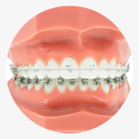 Clear Braces, HD Png Download, Free Download
