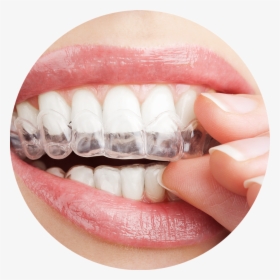 Transparent Teeth With Braces Clipart - Treatment For Teeth, HD Png Download, Free Download