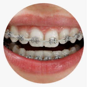 White Braces Power Chain, HD Png Download, Free Download