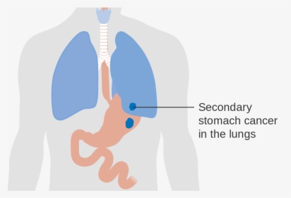 Diagram Showing Secondary Stomach Cancer In The Lungs - Stomach Lung, HD Png Download, Free Download