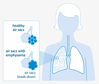 Diagram Of Lungs With Emphysema - Lung Reduction Surgery Copd, HD Png Download, Free Download