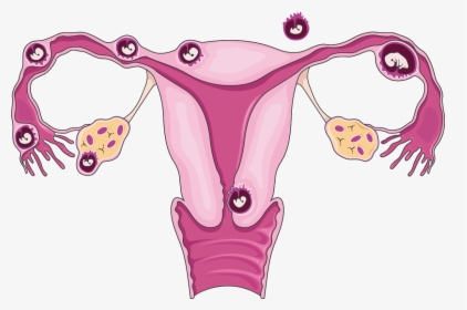 Download The Image - Ectopic Pregnancy Clipart, HD Png Download, Free Download