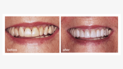 Shot Of Before And After Visiting Abington Smile Gallery - Aggression, HD Png Download, Free Download