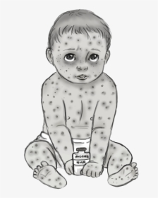 Measles Transparent, HD Png Download, Free Download