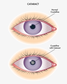 Difference Between Corneal Opacity And Cataract, HD Png Download, Free Download