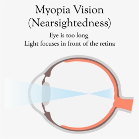 Myopic Eye-02 - Circle, HD Png Download, Free Download