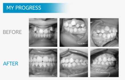 Chicago Orthodontics Braces - Teeth Xray Before And After Braces, HD Png Download, Free Download