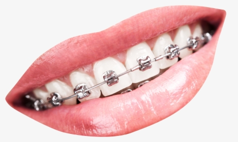 Teeth With Braces Png, Transparent Png, Free Download
