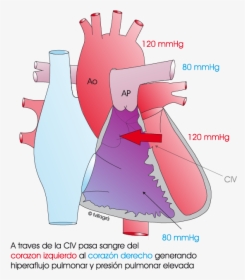 Hipertensión Pulmonar Persistente Del Recién Nacido, HD Png Download, Free Download