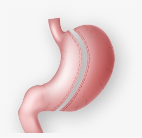 Demonstration Of Gastric Sleeve Surgery - Illustration, HD Png Download, Free Download