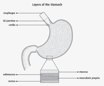 Stomach Carcinoma In Situ, HD Png Download, Free Download