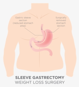 Gastric Sleeve Stomash Removal, HD Png Download, Free Download