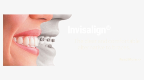 Barry Dentistry Invisalign Kirkland - Clear Aligners, HD Png Download, Free Download