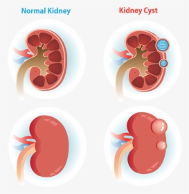 Comparison Of Normal Kidney Verse A Kidney With A Cyst - Kidney Cyst, HD Png Download, Free Download
