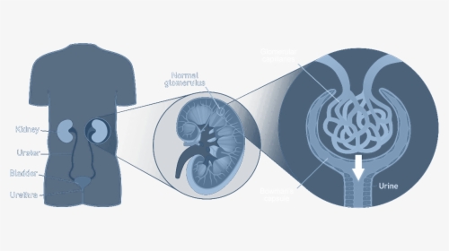 Fabry Disease Renal Symptoms Graphical Image - Renal Failure Fabry, HD Png Download, Free Download