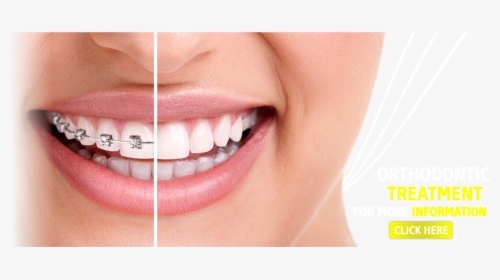Braces With Straight Teeth, HD Png Download, Free Download