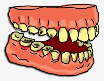 Teeth Clipart Dental Cleaning - Tooth Decay Clip Art, HD Png Download, Free Download