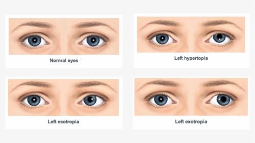 What Is Squint Or Strabismus - Squint In Eyes, HD Png Download, Free Download