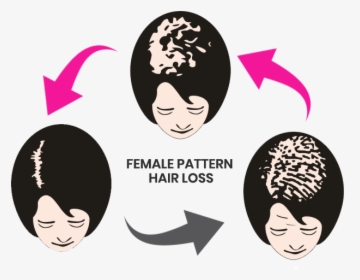 Alopecia, HD Png Download, Free Download