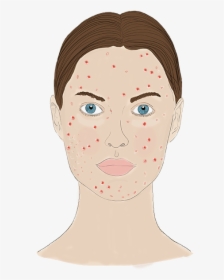 Acne Png Page, Transparent Png, Free Download