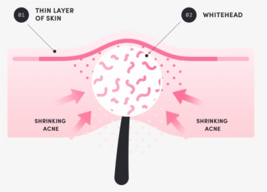 Acne Png, Transparent Png, Free Download