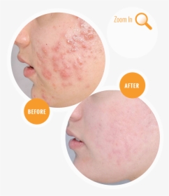 Acne Before And After Treatment, HD Png Download, Free Download