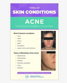Acne Png, Transparent Png, Free Download
