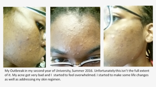 Second Year Acne Before, HD Png Download, Free Download