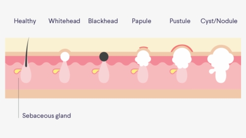 Acne Png, Transparent Png, Free Download