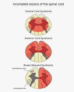 File - Cord-en - Incomplete Spinal Cord Lesions, HD Png Download, Free Download