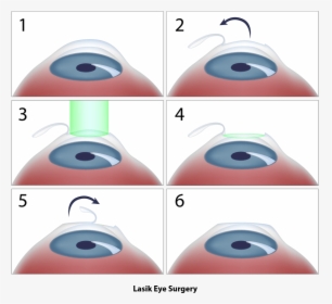 Lasik Procedure Flap - Lézeres Szemműtét, HD Png Download, Free Download